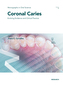 Coronal Caries
